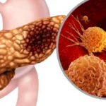 Avance sin precedentes contra el cáncer de páncreas: una terapia triple elimina tumores en modelos animales cáncer de páncreas