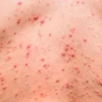 Alerta en Bahía Blanca: la sífilis se dispara 88% y enciende preocupación sanitaria Sífilis-02_acervo-AGECOM
